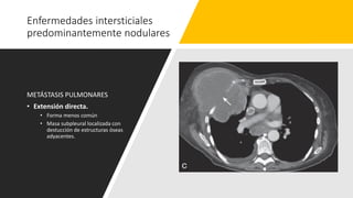 Enfermedades intersticiales
predominantemente nodulares
METÁSTASIS PULMONARES
• Extensión directa.
• Forma menos común
• Masa subpleural localizada con
destucción de estructuras óseas
adyacentes.
 