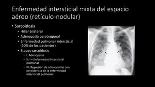 Enfermedad intersticial mixta del espacio
aéreo (retículo-nodular)
• Sarcoidosis
• Hiliar bilateral
• Adenopatía paratraqueal
• Enfermedad pulmonar intersticial
(50% de los pacientes)
• Etapas sarcoidosis
• I: Adenopatía
• II: I + Enfermedad intersticial
pulmonar
• III: Regresión de adenopatías con
persistencia de la enfermedad
intersticial pulmonar.
 