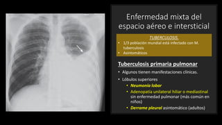 Enfermedad mixta del
espacio aéreo e intersticial
Tuberculosis primaria pulmonar
• Algunos tienen manifestaciones clínicas.
• Lóbulos superiores
• Neumonía lobar
• Adenopatía unilateral hiliar o mediastinal
sin enfermedad pulmonar (más común en
niños)
• Derrame pleural asintomático (adultos)
TUBERCULOSIS.
• 1/3 población mundial está infectado con M.
tuberculosis
• Asintomáticos
 