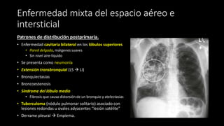 Enfermedad mixta del espacio aéreo e
intersticial
Patrones de distribución postprimaria.
• Enfermedad cavitaria bilateral en los lóbulos superiores
• Pared delgada, márgenes suaves
• Sin nivel aire-líquido
• Se presenta como neumonía
• Extensión transbronquial (LS  LI)
• Bronquiectasias
• Broncoestenosis
• Síndrome del lóbulo medio
• Fibrosis que causa distorsión de un bronquio y atelectasias
• Tuberculoma (nódulo pulmonar solitario) asociado con
lesiones redondas u ovales adyacentes “lesión satélite”
• Derrame pleural  Empiema.
 
