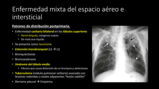 Enfermedad mixta del espacio aéreo e
intersticial
Patrones de distribución postprimaria.
• Enfermedad cavitaria bilateral en los lóbulos superiores
• Pared delgada, márgenes suaves
• Sin nivel aire-líquido
• Se presenta como neumonía
• Extensión transbronquial (LS  LI)
• Bronquiectasias
• Broncoestenosis
• Síndrome del lóbulo medio
• Fibrosis que causa distorsión de un bronquio y atelectasias
• Tuberculoma (nódulo pulmonar solitario) asociado con
lesiones redondas u ovales adyacentes “lesión satélite”
• Derrame pleural  Empiema.
 