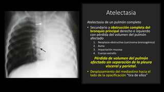 Atelectasia
Atelectasia de un pulmón completo
• Secundario a obstrucción completa del
bronquio principal derecho e izquierdo
con pérdida del volumen del pulmón
afectado
1. Neoplasia obstructiva (carcinoma broncogénico)
2. Asma
3. Impactación mucosa
4. Cuerpo extraño
Pérdida de volumen del pulmón
afectado sin separación de la pleura
visceral y parietal.
• Desplazamiento del mediastino hacia el
lado de la opacificación “tira de ellos”
 