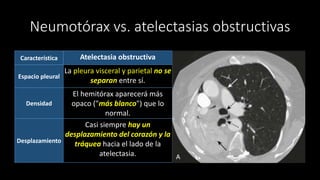 Neumotórax vs. atelectasias obstructivas
Característica Atelectasia obstructiva
Espacio pleural
La pleura visceral y parietal no se
separan entre sí.
Densidad
El hemitórax aparecerá más
opaco ("más blanco") que lo
normal.
Desplazamiento
Casi siempre hay un
desplazamiento del corazón y la
tráquea hacia el lado de la
atelectasia.
 
