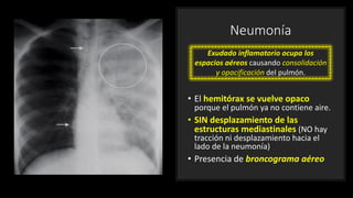 Neumonía
• El hemitórax se vuelve opaco
porque el pulmón ya no contiene aire.
• SIN desplazamiento de las
estructuras mediastinales (NO hay
tracción ni desplazamiento hacia el
lado de la neumonía)
• Presencia de broncograma aéreo
Exudado inflamatorio ocupa los
espacios aéreos causando consolidación
y opacificación del pulmón.
 