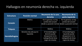 Hallazgos en neumonía derecha vs. izquierda
Estructura Posición normal
Neumonía de la cara
derecha
Neumonía de la
parte izquierda
Corazón
Midline Por lo general, no hay
cambio del corazón
desde su posición normal
Por lo general, no hay
cambio del corazón
desde su posición normal
Tráquea Midline Midline Midline
Hemidiafragma
Derecha más alta que la
izquierda
El hemidiafragma
derecho puede
desaparecer en la
radiografía de tórax
(signo de silueta)
El hemidiafragma
izquierdo puede
desaparecer en la
radiografía de tórax
(signo de silueta)
 