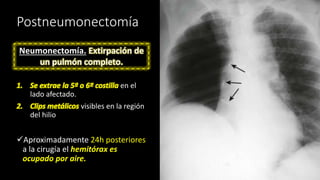 Postneumonectomía
1. Se extrae la 5ª o 6ª costilla en el
lado afectado.
2. Clips metálicos visibles en la región
del hilio
✓Aproximadamente 24h posteriores
a la cirugía el hemitórax es
ocupado por aire.
Neumonectomía. Extirpación de
un pulmón completo.
 
