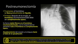 Postneumonectomía
✓2 semanas, el hemitórax
se llena gradualmente de líquido.
✓4 meses después de la cirugía, el
hemitórax neumonectomizado debe
ser completamente opaco.
Se forma tejido fibroso en el hemitórax
neumonectomizado, y en la mayoría de los
pacientes todo el hemitórax es completamente
opaco.
Desplazamiento del corazón y la tráquea hacia
el lado de la opacificación.
El examen de tórax es idéntico al de un paciente con atelectasia de todo el pulmón. Para ver la diferencia, buscar la
falta 5 º o 6 º costillas y buscar los clips quirúrgicos en el hilio para indicar que se ha realizado una neumonectomía
 
