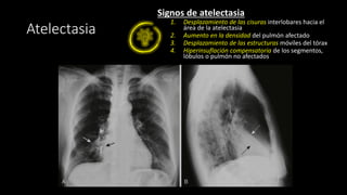 Atelectasia
Signos de atelectasia
1. Desplazamiento de las cisuras interlobares hacia el
área de la atelectasia
2. Aumento en la densidad del pulmón afectado
3. Desplazamiento de las estructuras móviles del tórax
4. Hiperinsuflación compensatoria de los segmentos,
lóbulos o pulmón no afectados
 