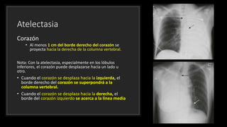 Atelectasia
Corazón
• Al menos 1 cm del borde derecho del corazón se
proyecta hacia la derecha de la columna vertebral.
Nota: Con la atelectasia, especialmente en los lóbulos
inferiores, el corazón puede desplazarse hacia un lado u
otro.
• Cuando el corazón se desplaza hacia la izquierda, el
borde derecho del corazón se superpondrá a la
columna vertebral.
• Cuando el corazón se desplaza hacia la derecha, el
borde del corazón izquierdo se acerca a la línea media
 