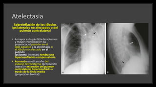 Atelectasia
Sobreinflación de los lóbulos
ipsilaterales no afectados o del
pulmón contralateral
• A mayor es la pérdida de volumen
y mayor cronicidad en su
presencia, el pulmón en el
lado opuesto a la atelectasia o
el lóbulo no afectado en el
pulmón
ipsilateral intentará tendrá una
hiperinsuflación compensatoria.
• Aumento en el tamaño del
espacio retroesternal (proyección
lateral) y extensión del pulmón
contralateral hiperinsuflado a
través de la línea media
(proyección frontal)
 