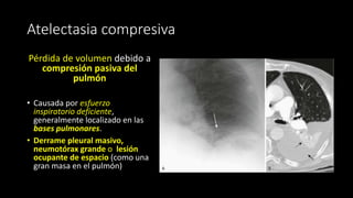 Atelectasia compresiva
Pérdida de volumen debido a
compresión pasiva del
pulmón
• Causada por esfuerzo
inspiratorio deficiente,
generalmente localizado en las
bases pulmonares.
• Derrame pleural masivo,
neumotórax grande o lesión
ocupante de espacio (como una
gran masa en el pulmón)
 