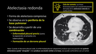 Atelectasia redonda
• Forma de atelectasia compresiva
• Se observa en la periferia de la
base pulmonar
• Se desarrolla a partir de una
combinación
• Enfermedad pleural previa (como
la exposición al amianto o la
tuberculosis)
• Formación de un derrame pleural
Cola de cometa. Las líneas
broncovasculares son característicamente
derivadas de la atelectasia redonda de
vuelta al hilio
Nota: Cuando el derrame pleural cede, la enfermedad pleural subyacente produce que una porción del pulmón
atelectásico quede "atrapado". Esto produce una lesión similar a la masa. eso puede confundirse con un tumor
 