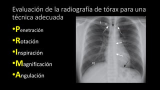 Evaluación de la radiografía de tórax para una
técnica adecuada
•P
•R
•I
•M
•A
•Penetración
•Rotación
•Inspiración
•Magnificación
•Angulación
 