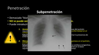 Penetración
Subpenetración
• Demasiado “blanda”
• NO se puede ver la columna torácica a través del corazón.
• Puede introducir al menos 2 errores en su interpretación:
1. Hemidiafragma izquierdo puede no ser visible porque la base del pulmón
izquierdo puede parecer opaca. Podría imitar u ocultar una enfermedad en el
campo pulmonar inferior izquierdo.
Solución: observe la radiografía de tórax lateral para confirmar la presencia de
enfermedad en la base izquierda
2. Marcas pulmonares, que son principalmente los vasos sanguíneos en el pulmón,
pueden parecer más prominentes de lo que realmente son.
Soluciones: busque otros signos radiológicos de insuficiencia cardíaca congestiva,
marcas aumentadas, enfermedad del espacio aéreo o derrame en la base
izquierda que sospechaba sobre la base de la radiografía frontal.
 