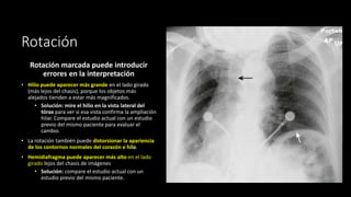 Rotación
Rotación marcada puede introducir
errores en la interpretación
• Hilio puede aparecer más grande en el lado girado
(más lejos del chasis), porque los objetos más
alejados tienden a estar más magnificados.
• Solución: mire el hilio en la vista lateral del
tórax para ver si esa vista confirma la ampliación
hilar. Compare el estudio actual con un estudio
previo del mismo paciente para evaluar el
cambio.
• La rotación también puede distorsionar la apariencia
de los contornos normales del corazón e hilo.
• Hemidiafragma puede aparecer más alto en el lado
girado lejos del chasis de imágenes
• Solución: compare el estudio actual con un
estudio previo del mismo paciente.
 