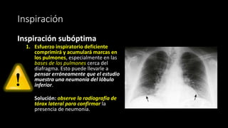 Inspiración
Inspiración subóptima
1. Esfuerzo inspiratorio deficiente
comprimirá y acumulará marcas en
los pulmones, especialmente en las
bases de los pulmones cerca del
diafragma. Esto puede llevarle a
pensar erróneamente que el estudio
muestra una neumonía del lóbulo
inferior.
Solución: observe la radiografía de
tórax lateral para confirmar la
presencia de neumonía.
 