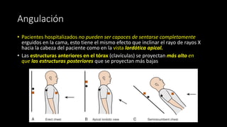 Angulación
• Pacientes hospitalizados no pueden ser capaces de sentarse completamente
erguidos en la cama, esto tiene el mismo efecto que inclinar el rayo de rayos X
hacia la cabeza del paciente como en la vista lordótica apical.
• Las estructuras anteriores en el tórax (clavículas) se proyectan más alto en
que las estructuras posteriores que se proyectan más bajas
 