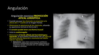 Angulación
Angulación excesiva PROYECCIÓN
APICAL LORDÓTICA.
• Cuando vea que las clavículas se proyectan a la
altura del 1 er costilla en la imagen frontal.
• Distorsiona la apariencia de las clavículas, alisando
su apariencia normal en forma de S
• El corazón puede tener una forma inusual
• Imita la cardiomegalia
• Distorsiona el borde afilado del hemidiafragma
izquierdo, lo que podría confundirse con un signo de
derrame pleural izquierdo o neumonía del lóbulo
inferior izquierdo.
• Soluciones: sepa cómo reconocer los artefactos
técnicos y comprenda cómo pueden distorsionar la
anatomía normal. Consulte con un radiólogo sobre
imágenes confusas.
 