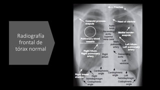 Radiografía
frontal de
tórax normal
 