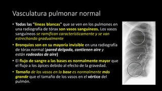 Vasculatura pulmonar normal
• Todas las "líneas blancas" que se ven en los pulmones en
una radiografía de tórax son vasos sanguíneos. Los vasos
sanguíneos se ramifican característicamente y se van
estrechando gradualmente
• Bronquios son en su mayoría invisible en una radiografía
de tórax normal (pared delgada, contienen aire y
están rodeados de aire)
• El flujo de sangre a las bases es normalmente mayor que
el flujo a los ápices debido al efecto de la gravedad.
• Tamaño de los vasos en la base es normalmente más
grande que el tamaño de los vasos en el vértice del
pulmón.
 