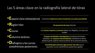 Las 5 áreas clave en la radiografía lateral de tórax
•Espacio claro retroesternal
•Región hilar
•Cisuras
•Columna torácica
•Diafragma y los surcos
costofrénicos posteriores
Creciente media luna entre el esternón y la aorta ascendente
Sin presencia de masa discreta
Las cisuras mayores y menores deben ser delgadas, si es que son
visibles
Cuerpos vertebrales rectangulares con placas terminales
paralelas; los espacios intervertebrales mantienen la altura
desde la parte superior hasta la inferior de la columna torácica
Hemidiafragma derecho ligeramente más alto que el
izquierdo; surcos costofrénicos posteriores agudos
 