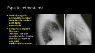Espacio retroesternal
• Media luna justo
detrás del esternón y
anterior a la sombra
de la aorta
ascendente.
• Busque este espacio
libre para
"rellenar" con una
densidad de los tejidos
blandos cuando hay
una masa
mediastínica anterior.
 