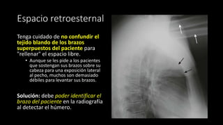 Espacio retroesternal
Tenga cuidado de no confundir el
tejido blando de los brazos
superpuestos del paciente para
"rellenar" el espacio libre.
• Aunque se les pide a los pacientes
que sostengan sus brazos sobre su
cabeza para una exposición lateral
al pecho, muchos son demasiado
débiles para levantar sus brazos.
Solución: debe poder identificar el
brazo del paciente en la radiografía
al detectar el húmero.
 