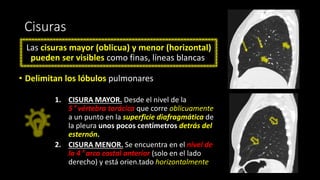 Cisuras
Las cisuras mayor (oblicua) y menor (horizontal)
pueden ser visibles como finas, líneas blancas
• Delimitan los lóbulos pulmonares
1. CISURA MAYOR. Desde el nivel de la
5 ª vértebra torácica que corre oblicuamente
a un punto en la superficie diafragmática de
la pleura unos pocos centímetros detrás del
esternón.
2. CISURA MENOR. Se encuentra en el nivel de
la 4 ª arco costal anterior (solo en el lado
derecho) y está orien.tado horizontalmente
 