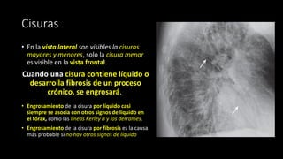 Cisuras
• En la vista lateral son visibles la cisuras
mayores y menores, solo la cisura menor
es visible en la vista frontal.
Cuando una cisura contiene líquido o
desarrolla fibrosis de un proceso
crónico, se engrosará.
• Engrosamiento de la cisura por líquido casi
siempre se asocia con otros signos de líquido en
el tórax, como las líneas Kerley B y los derrames.
• Engrosamiento de la cisura por fibrosis es la causa
más probable si no hay otros signos de líquido
 