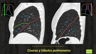 LSD
LSI
LII
LID
LM
Cisuras y lóbulos pulmonares
 