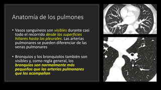 Anatomía de los pulmones
• Vasos sanguíneos son visibles durante casi
todo el recorrido desde las superficies
hiliares hasta las pleurales. Las arterias
pulmonares se pueden diferenciar de las
venas pulmonares
• Bronquios y los bronquiolos también son
visibles y, como regla general, los
bronquios son normalmente más
pequeños que las arterias pulmonares
que los acompañan
 