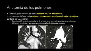 Anatomía de los pulmones
• Tráquea, generalmente de forma ovalada de 2 cm de diámetro.
• La tráquea se bifurca en la carina en los bronquios principales derecho e izquierdo
Ventana aortopulmonar.
▪ Espacio visible justo debajo del arco de la aorta pero por encima de la arteria pulmonar.
▪ Ubicación común para que aparezcan los ganglios linfáticos agrandados.
 