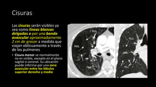 Cisuras
Las cisuras serán visibles ya
sea como líneas blancas
delgadas o por una banda
avascular aproximadamente
2 cm de grosor a medida que
viajan oblicuamente a través
de los pulmones
• Cisura menor se normalmente
no es visible, excepto en el plano
sagital o coronal. Su ubicación
puede inferirse por una zona
avascular entre los lóbulos
superior derecho y medio
 
