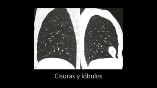 Cisuras y lóbulos
 