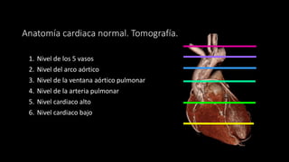 Anatomía cardiaca normal. Tomografía.
1. Nivel de los 5 vasos
2. Nivel del arco aórtico
3. Nivel de la ventana aórtico pulmonar
4. Nivel de la arteria pulmonar
5. Nivel cardiaco alto
6. Nivel cardiaco bajo
 