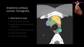 Anatomía cardiaca
normal. Tomografía.
1. Nivel de los 5 vasos
2. Nivel del arco aórtico
3. Nivel de la ventana aórtico
pulmonar
4. Nivel de la arteria pulmonar
5. Nivel cardiaco alto
6. Nivel cardiaco bajo
 