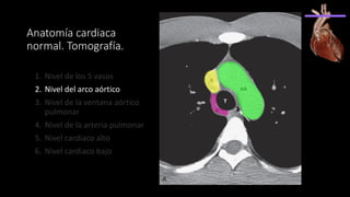 Anatomía cardiaca
normal. Tomografía.
1. Nivel de los 5 vasos
2. Nivel del arco aórtico
3. Nivel de la ventana aórtico
pulmonar
4. Nivel de la arteria pulmonar
5. Nivel cardiaco alto
6. Nivel cardiaco bajo
 