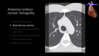 Anatomía cardiaca
normal. Tomografía.
1. Nivel de los 5 vasos
2. Nivel del arco aórtico
3. Nivel de la ventana aórtico
pulmonar
4. Nivel de la arteria pulmonar
5. Nivel cardiaco alto
6. Nivel cardiaco bajo
 