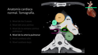 Anatomía cardiaca
normal. Tomografía.
1. Nivel de los 5 vasos
2. Nivel del arco aórtico
3. Nivel de la ventana aórtico
pulmonar
4. Nivel de la arteria pulmonar
5. Nivel cardiaco alto
6. Nivel cardiaco bajo
 