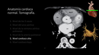 Anatomía cardiaca
normal. Tomografía.
1. Nivel de los 5 vasos
2. Nivel del arco aórtico
3. Nivel de la ventana aórtico
pulmonar
4. Nivel de la arteria pulmonar
5. Nivel cardiaco alto
6. Nivel cardiaco bajo
 