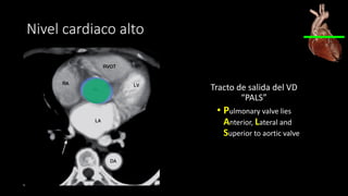 Nivel cardiaco alto
Tracto de salida del VD
“PALS”
• Pulmonary valve lies
Anterior, Lateral and
Superior to aortic valve
 