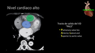 Nivel cardiaco alto
Tracto de salida del VD
“PALS”
• Pulmonary valve lies
Anterior, Lateral and
Superior to aortic valve
 