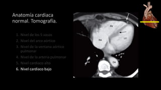 Anatomía cardiaca
normal. Tomografía.
1. Nivel de los 5 vasos
2. Nivel del arco aórtico
3. Nivel de la ventana aórtico
pulmonar
4. Nivel de la arteria pulmonar
5. Nivel cardiaco alto
6. Nivel cardiaco bajo
 
