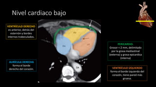 Nivel cardiaco bajo
AURÍCULA DERECHA
forma el borde
derecho del corazón.
VENTRÍCULO DERECHO
es anterior, detrás del
esternón y bordes
internos trabeculados.
VENTRÍCULO IZQUIERDO
forma el borde izquierdo del
corazón, tiene pared más
gruesa.
PERICARDIO.
Grosor < 2 mm, delimitado
por la grasa mediastinal
(externa) y grasa epicardica
(interna)
 