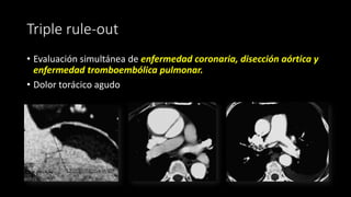 Triple rule-out
• Evaluación simultánea de enfermedad coronaria, disección aórtica y
enfermedad tromboembólica pulmonar.
• Dolor torácico agudo
 