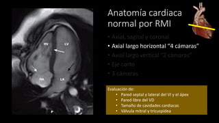Anatomía cardiaca
normal por RMI
• Axial, sagital y coronal
• Axial largo horizontal “4 cámaras”
• Axial largo vertical “2 cámaras”
• Eje corto
• 3 cámaras
Evaluación de:
• Pared septal y lateral del VI y el ápex
• Pared libre del VD
• Tamaño de cavidades cardiacas
• Válvula mitral y tricuspídea
 