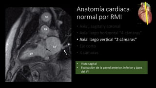 Anatomía cardiaca
normal por RMI
• Axial, sagital y coronal
• Axial largo horizontal “4 cámaras”
• Axial largo vertical “2 cámaras”
• Eje corto
• 3 cámaras
• Vista sagital
• Evaluación de la pared anterior, inferior y ápex
del VI
 
