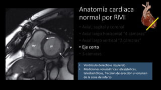 Anatomía cardiaca
normal por RMI
• Axial, sagital y coronal
• Axial largo horizontal “4 cámaras”
• Axial largo vertical “2 cámaras”
• Eje corto
• 3 cámaras
• Ventrículo derecho e izquierdo
• Mediciones volumétricas telesistólicas,
telediastólicas, fracción de eyección y volumen
de la zona de infarto
 