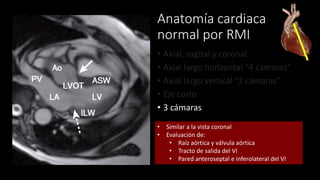 Anatomía cardiaca
normal por RMI
• Axial, sagital y coronal
• Axial largo horizontal “4 cámaras”
• Axial largo vertical “2 cámaras”
• Eje corto
• 3 cámaras
• Similar a la vista coronal
• Evaluación de:
• Raíz aórtica y válvula aórtica
• Tracto de salida del VI
• Pared anteroseptal e inferolateral del VI
 