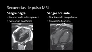 Secuencias de pulso MRI
Sangre negra
• Secuencia de pulso spin eco
• Evaluación anatómica
Sangre brillante
• Gradiente de eco pulsado
• Evaluación funcional
 